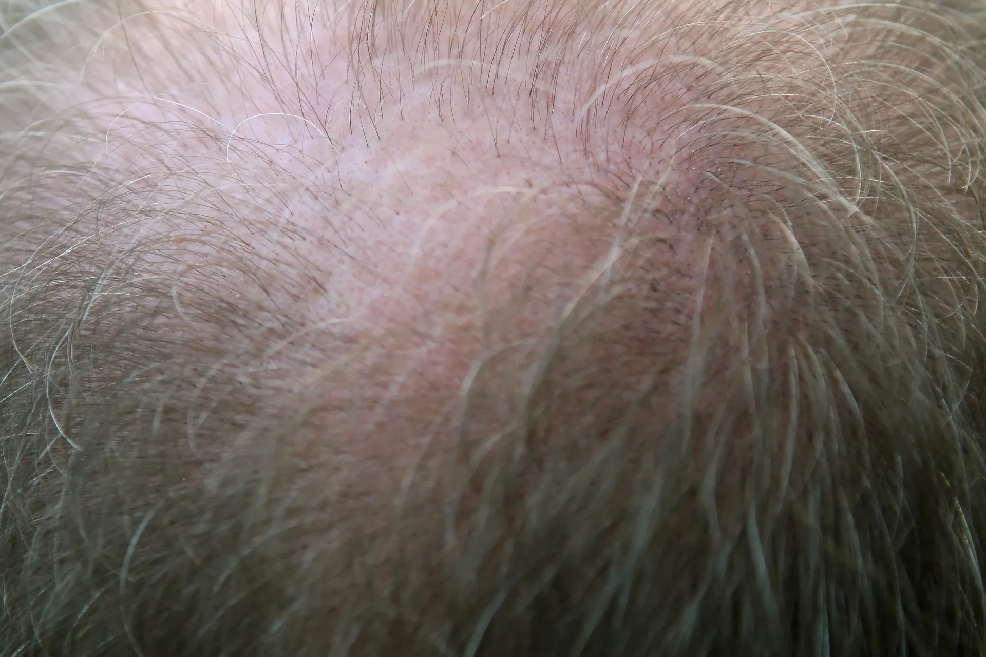Man examining his hair concerned about hair loss
